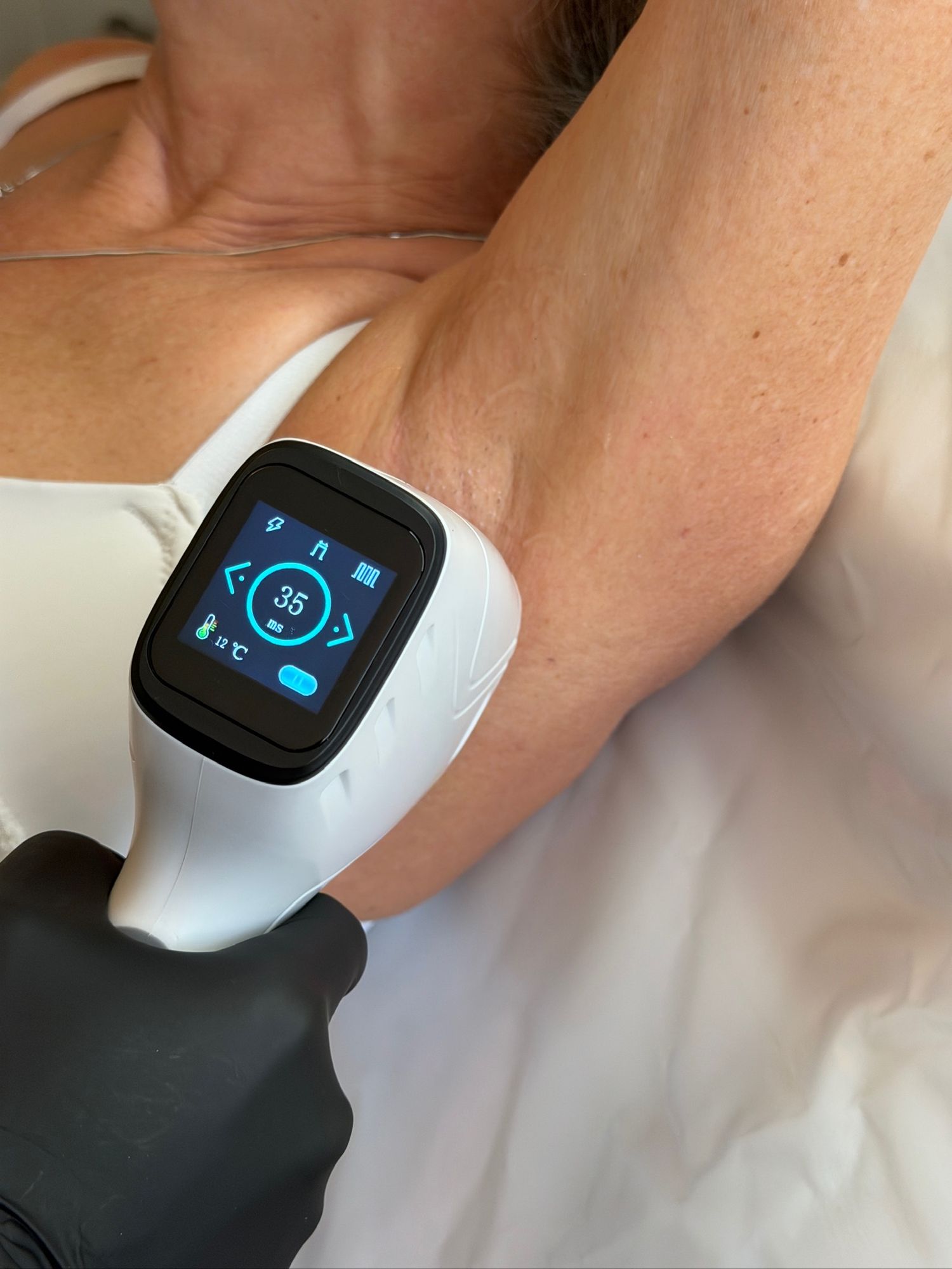 Laser hair removal device in use on the underarm, showing treatment settings