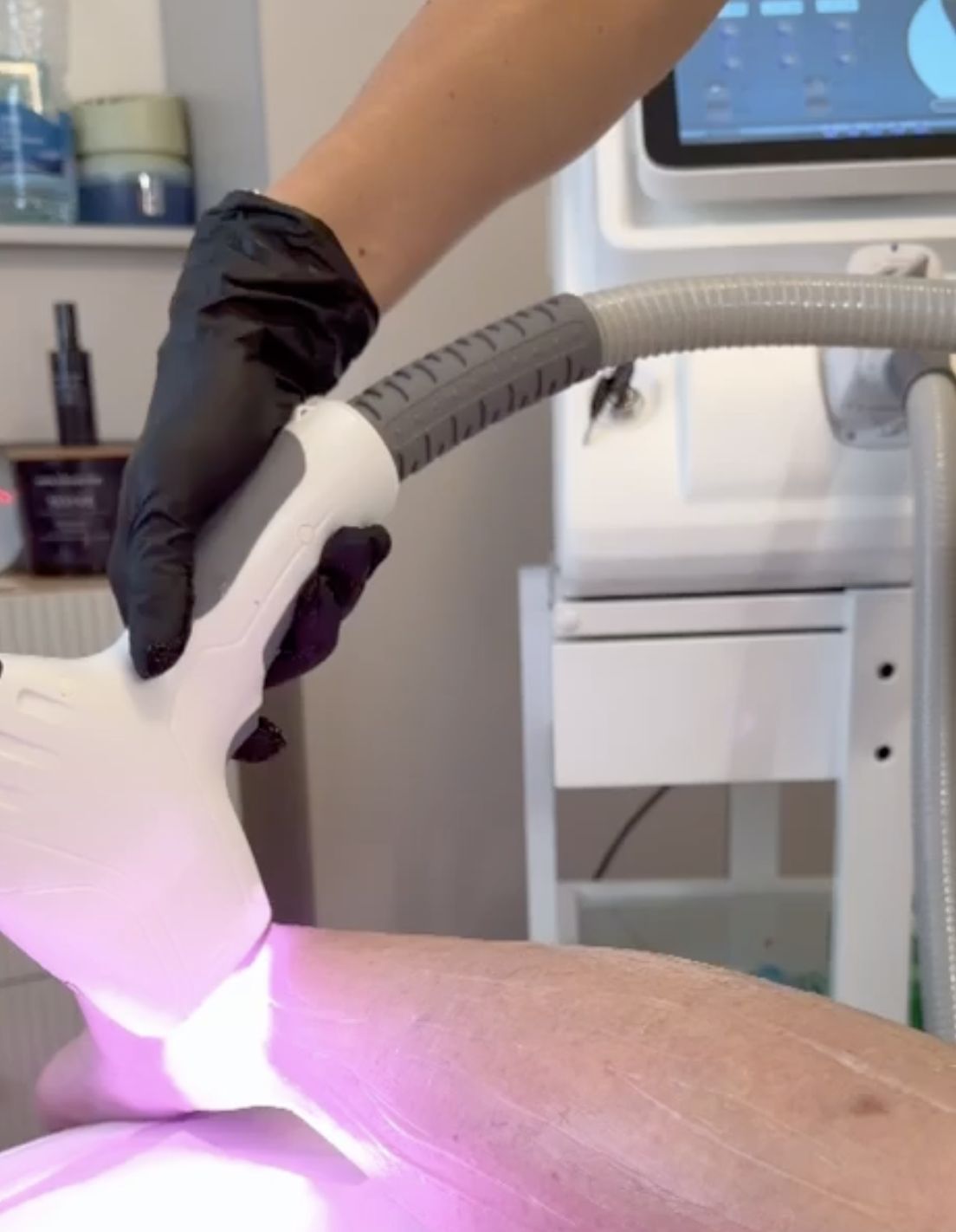 Close-up of laser hair removal treatment on the skin